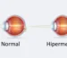 Hipermetrop Nedir?